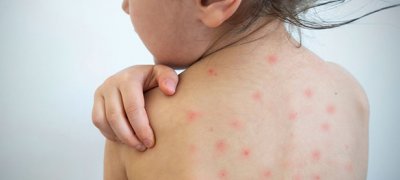 அதிகரித்து வரும் தட்டம்மை நோய்!